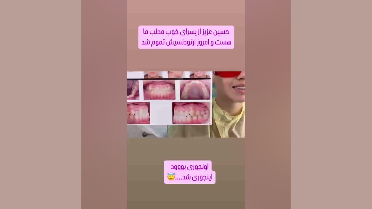 اصلاح مشکل جلوبودن فک پایین بدون جراحی و کشیدن دكتر مهدي فهيمي هنزائي