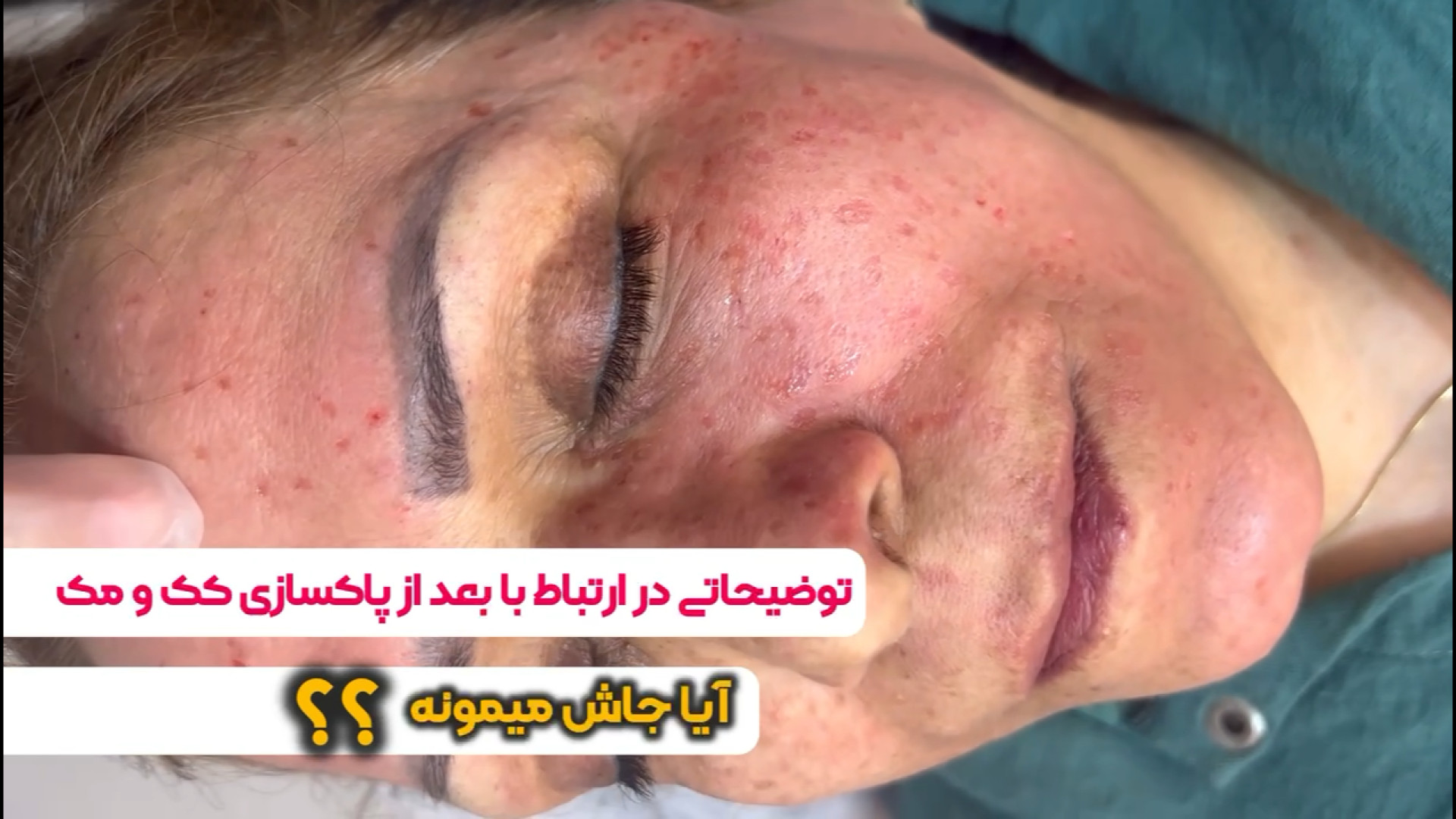 مرکز تخصصی پاکسازی کک و مک آفتاب ترمیم زیبایی دندان