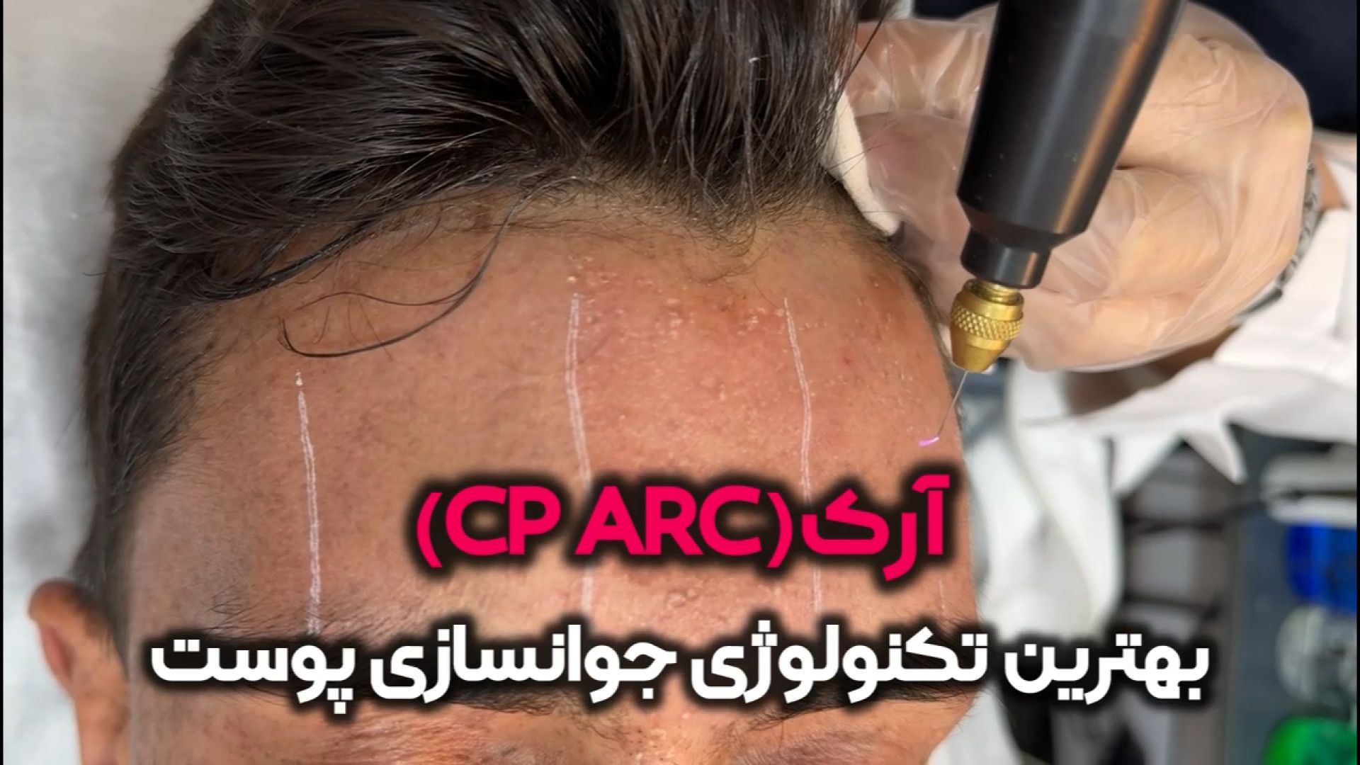 معجزه جوان سازی و روشن شدن پوست صورت با دستگاه آرک در کلینیک آفتاب جراحی پف زیر چشم