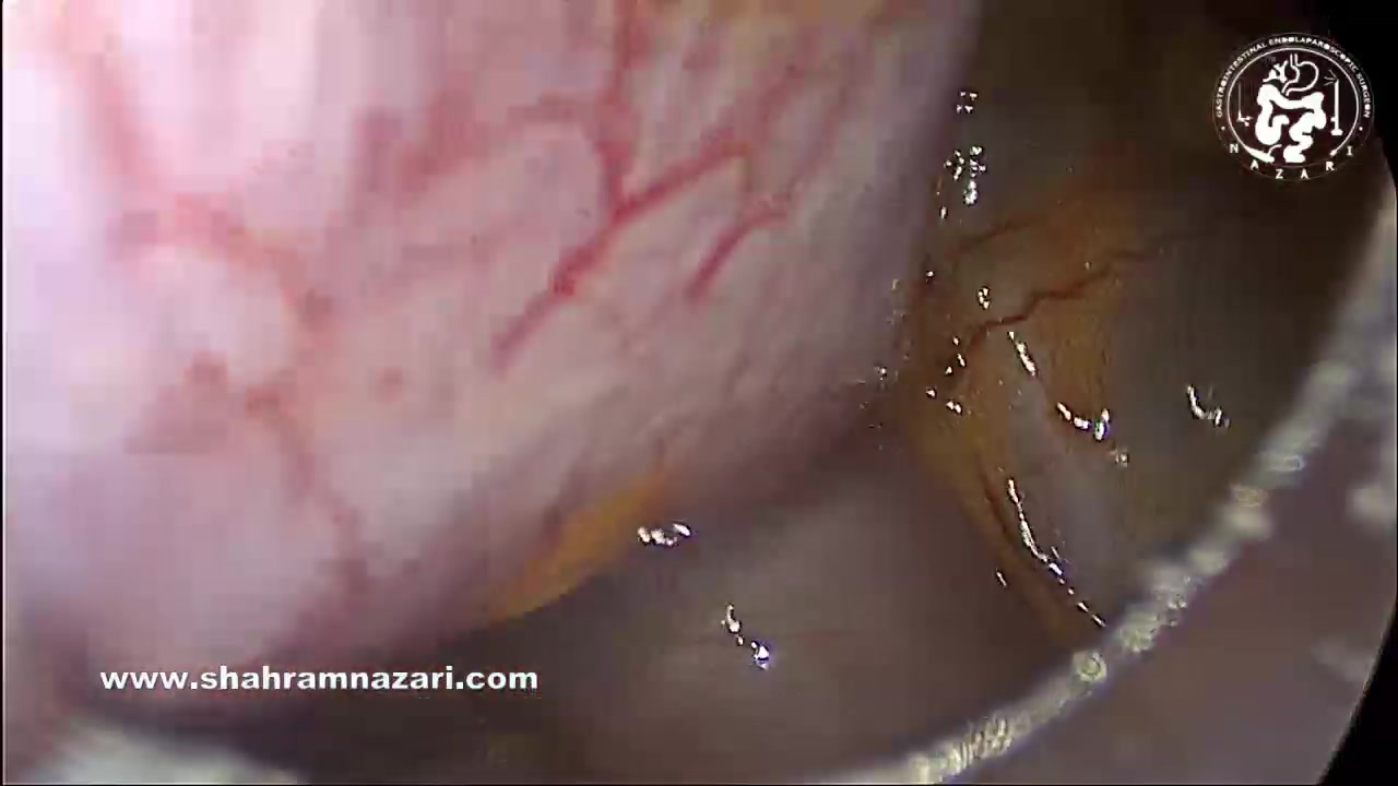 کوله‌سیستکتومی لاپاراسکوپیک ایمن زیبایی پوست