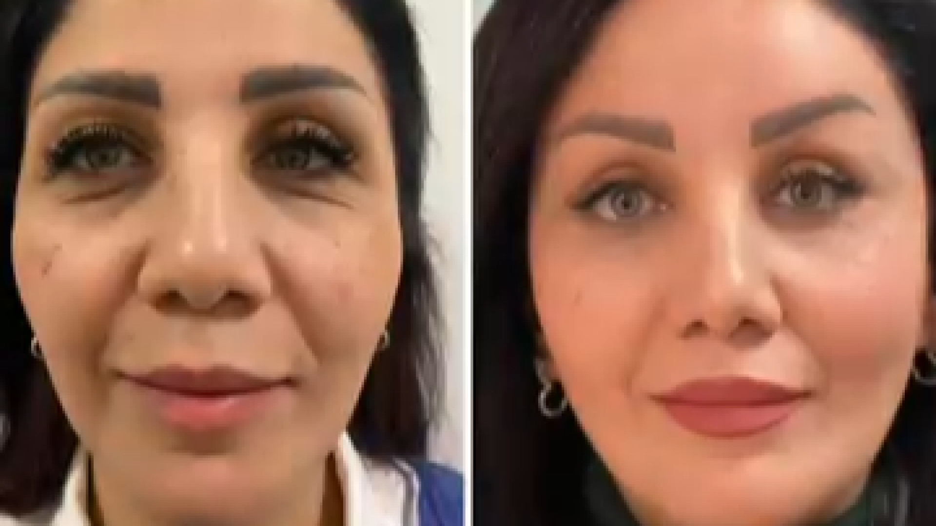نتیجه ۲ ماه بعد از لیفت اندوسکوپی ابرو، شقیقه و پلک دکتر شاهین بهجو - فوق تخصص جراحی پلاستیک