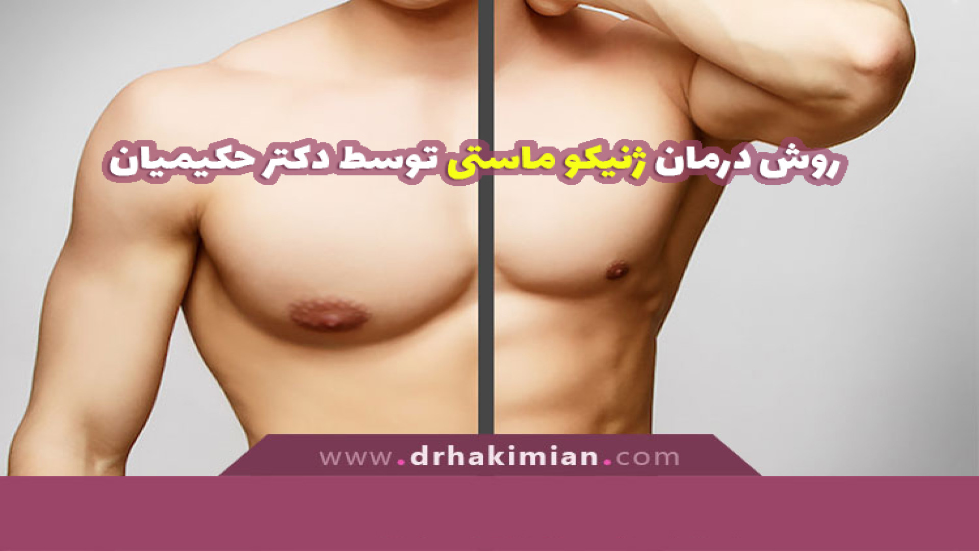 روش درمان ژنیکو ماستی توسط دکتر حکیمیان دندان شیری