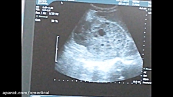 ultrasound pictures of kidney stones what does an ultrasound of kidney stones look like