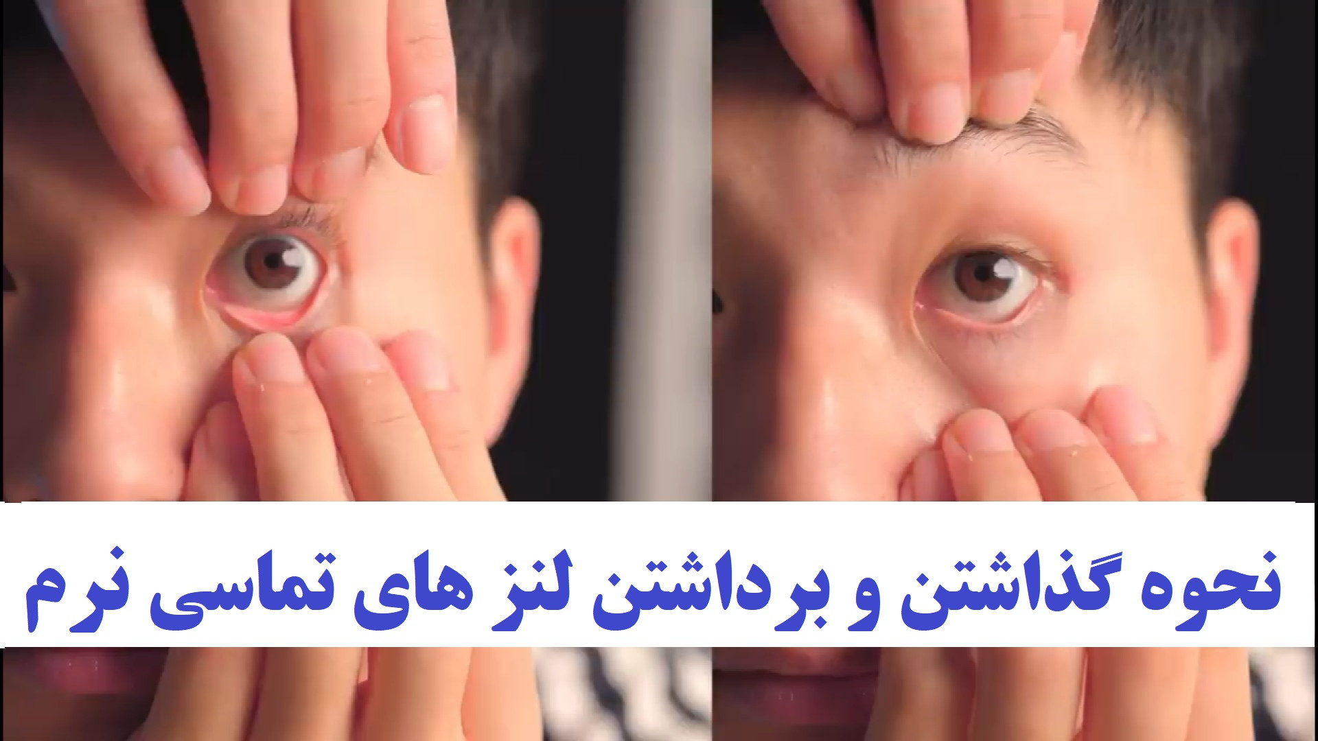نحوه گذاشتن و برداشتن لنز های تماسی نرم تری‌متازیدین