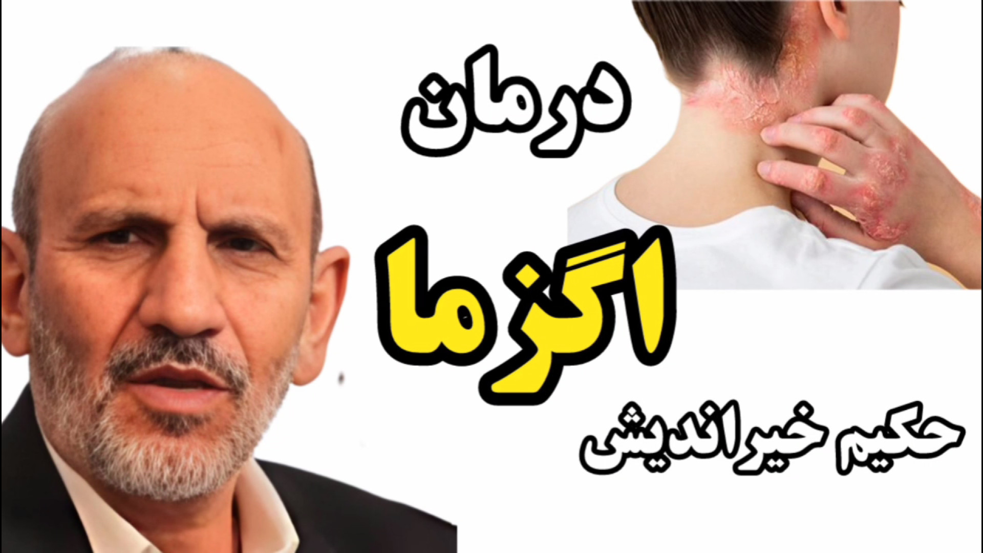 حکیم خیراندیش: اگزما رو از ریشه درمان کن! تلفن : 09366403577 رابرت داونی جونیور