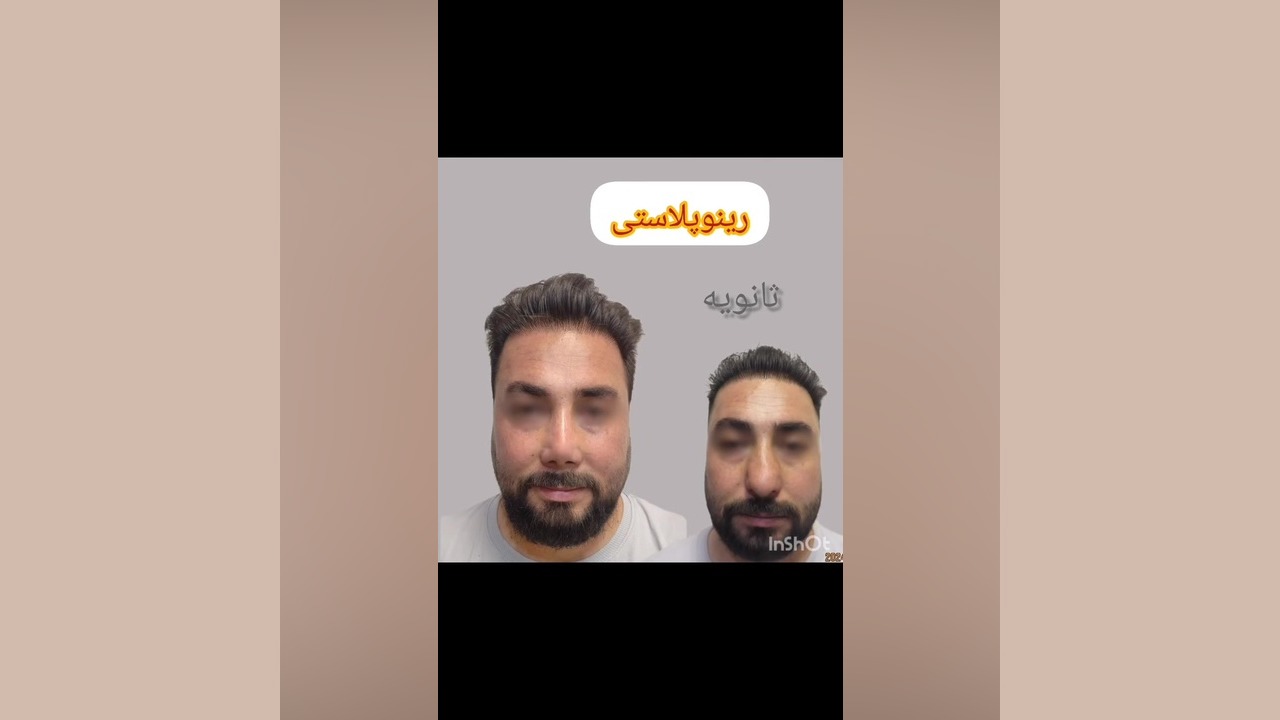 رینوپلاستی ثانویه بعد از ۳ماه دکتر محمودرضا اصحاب یمین - فوق تخصص پلاستیک