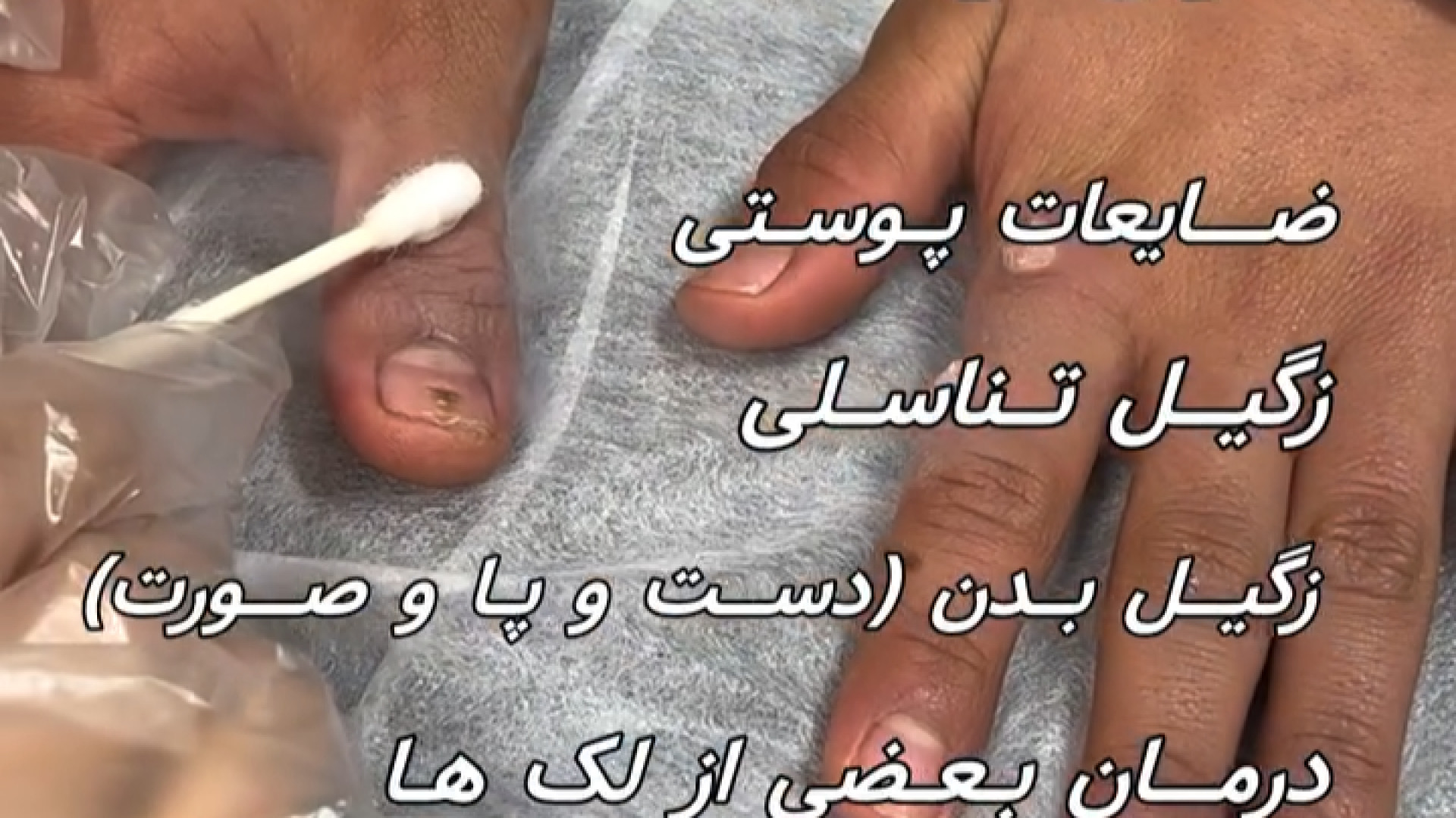 درمان زگیل با کرایوتراپی دکتر صدیقه نائیجی | متخصص پوست و مو در قم