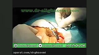 فیلم لیفت صورت با نخ خاردار (پارت 1 ) دکتر علی قاسمی(پوست ، مو ، زیبایی )