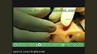 فیلم لیفت صورت با نخ خاردار (پارت 2) دکتر علی قاسمی(پوست ، مو ، زیبایی )