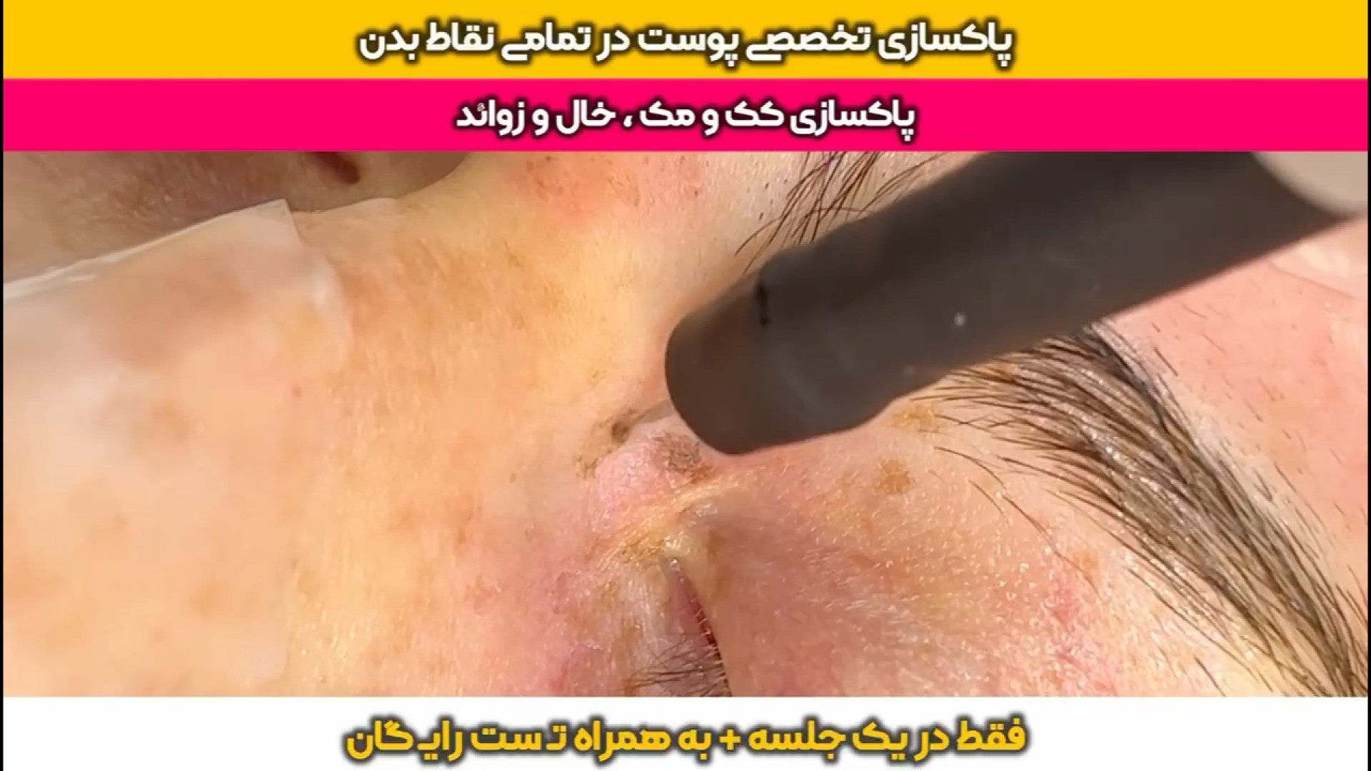 پاکسازی عمیق پوست با آر اف نانو بدون درد،بدون جای زخم در کلینیک تخصصی آفتاب HIDA Scan