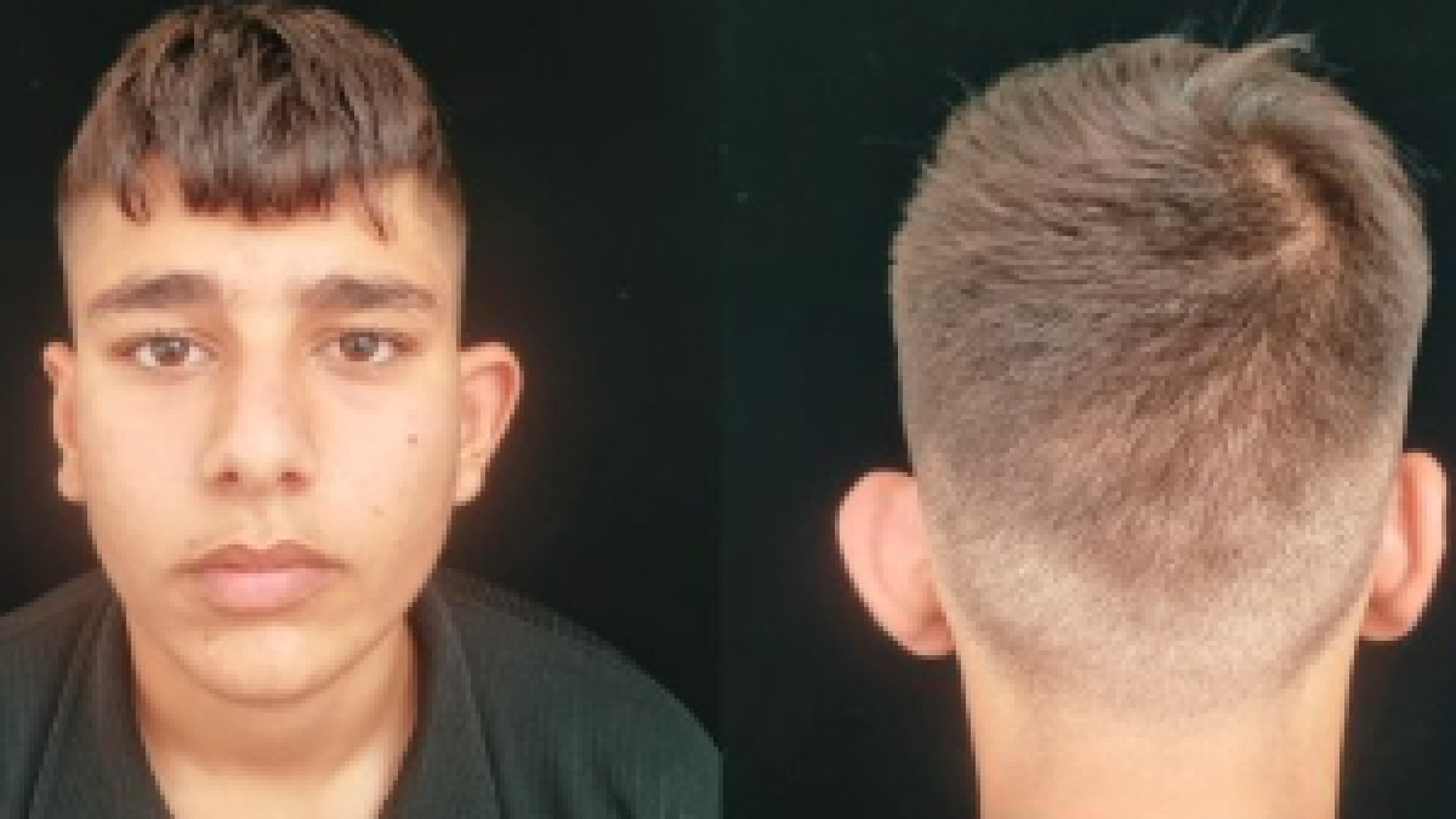 سه ساعت بعد از عمل برجستگی گوش دکتر ابراهیم حاتمی پور دکتر ابراهیم حاتمی پور