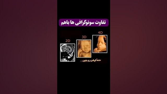 انواع سونوگرافی جنین الناز شاکردوست