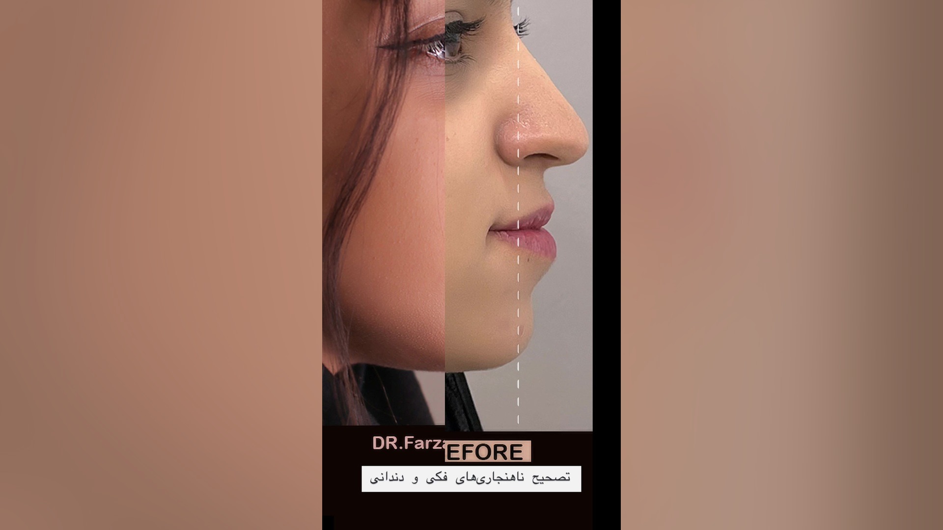 فیلم قبل و بعد از درمان ناهنجاری فک با جراحی فک و ارتودنسی پلتفرم ارگانوئید انسانی