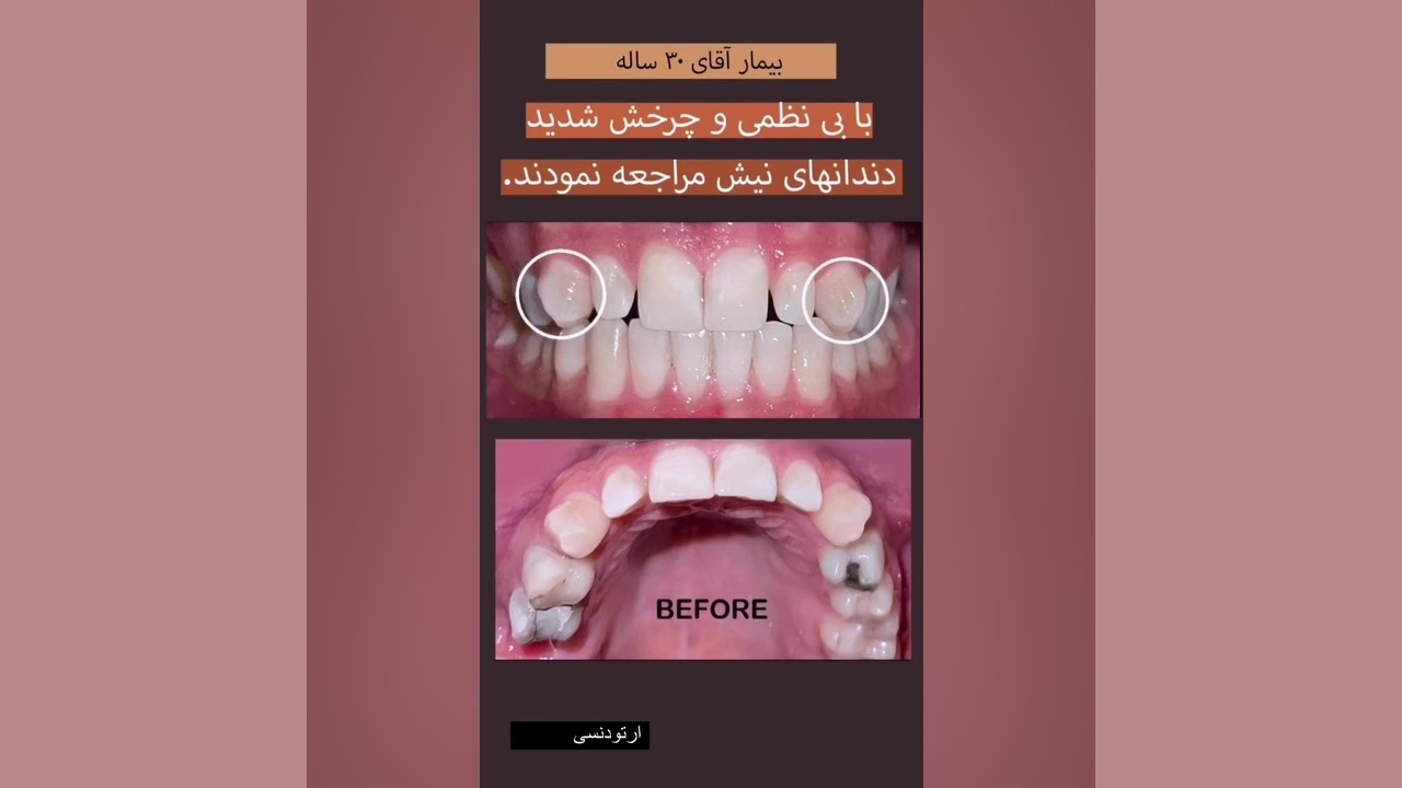 ارتودنسی دندان های نیش سیتوژنتیک مولکولی