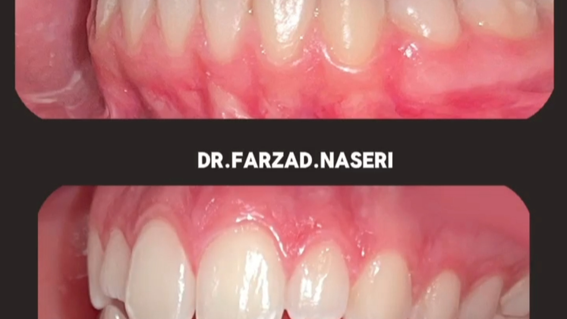 قبل و بعد ارتودنسی دو فک دکتر فرزاد ناصری متخصص ارتودنسی در اصفهان