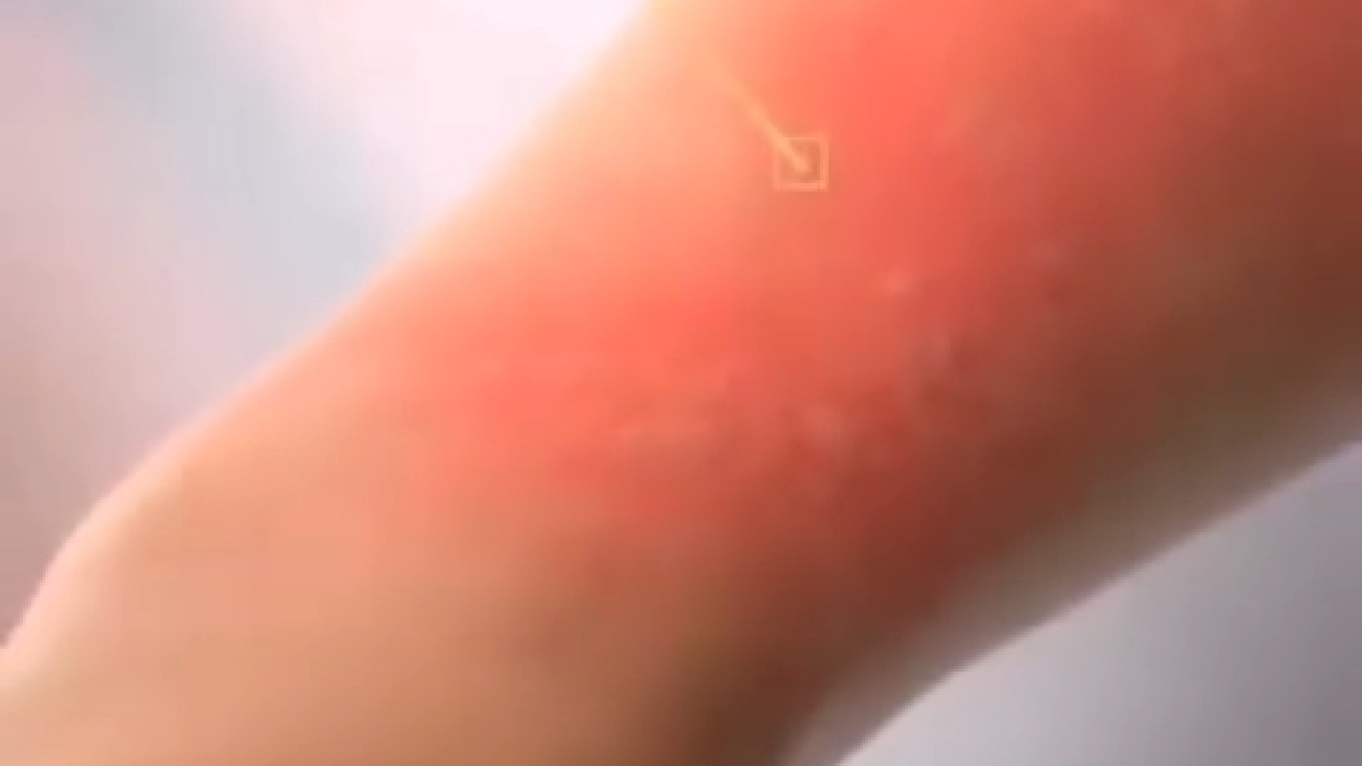 انیمیشنی از نحوه ایجاد کهیر دکتر شهرام سیدی متخصص آلرژی و ایمونولوژی