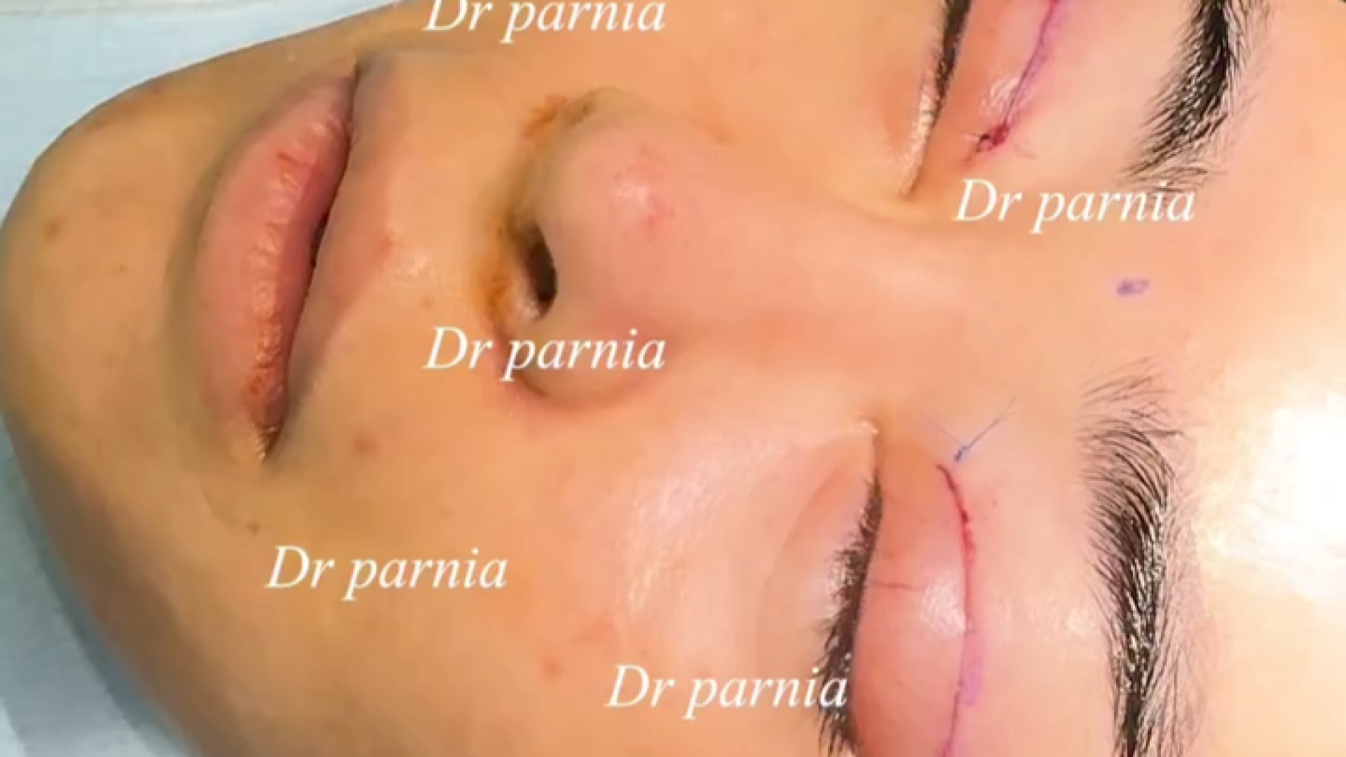 نتیجه لیفت آندوسکوپي پیشانی دکتر رفیع پرنیا فوق تخصص پلاستیک