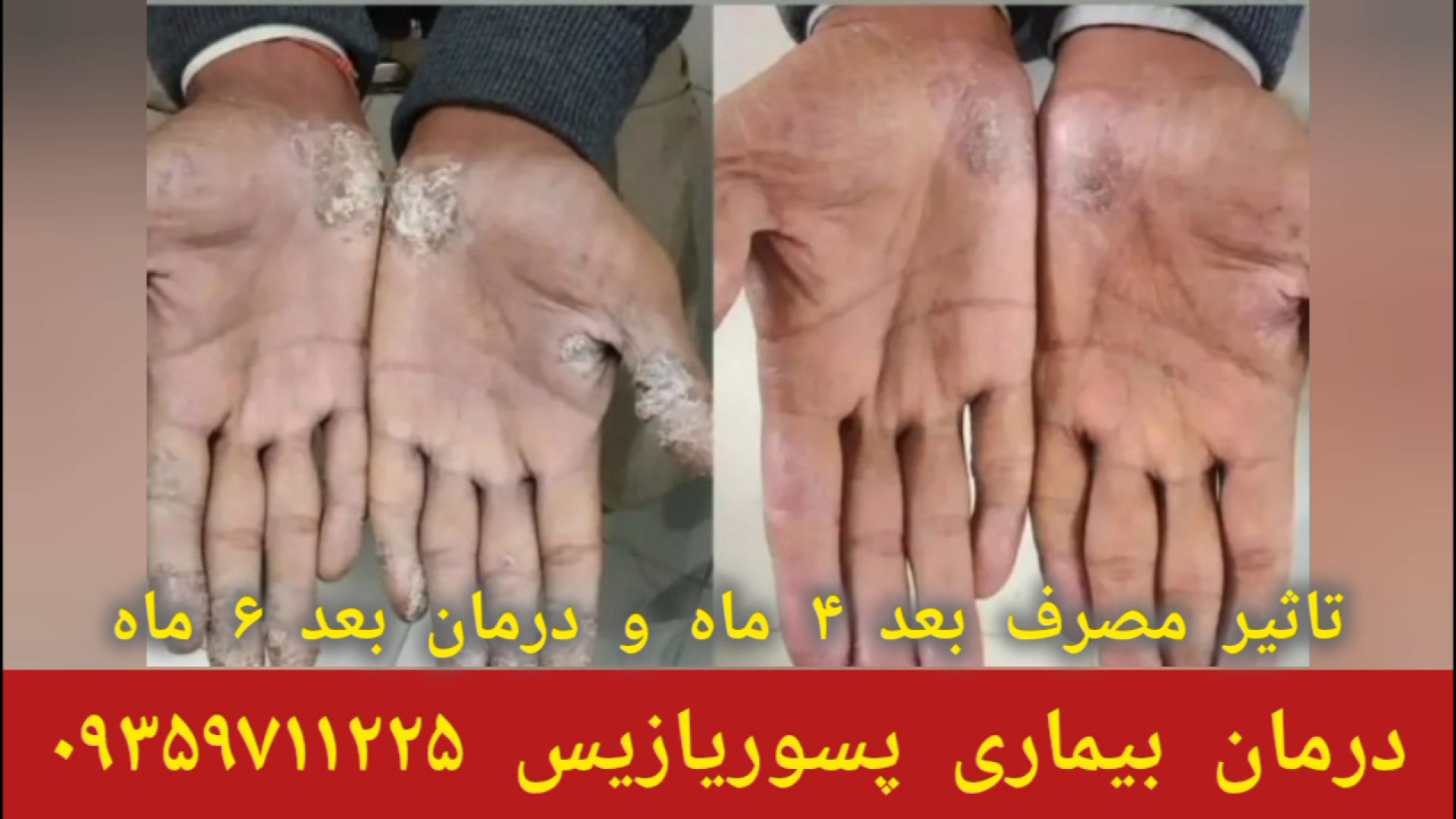 رضایت درمان بیماری پسوریازیس توسط،شاگردان حکیم خیراندیش ۰۹۳۵۹۷۱۱۲۲۵ لیزر موهای زائد