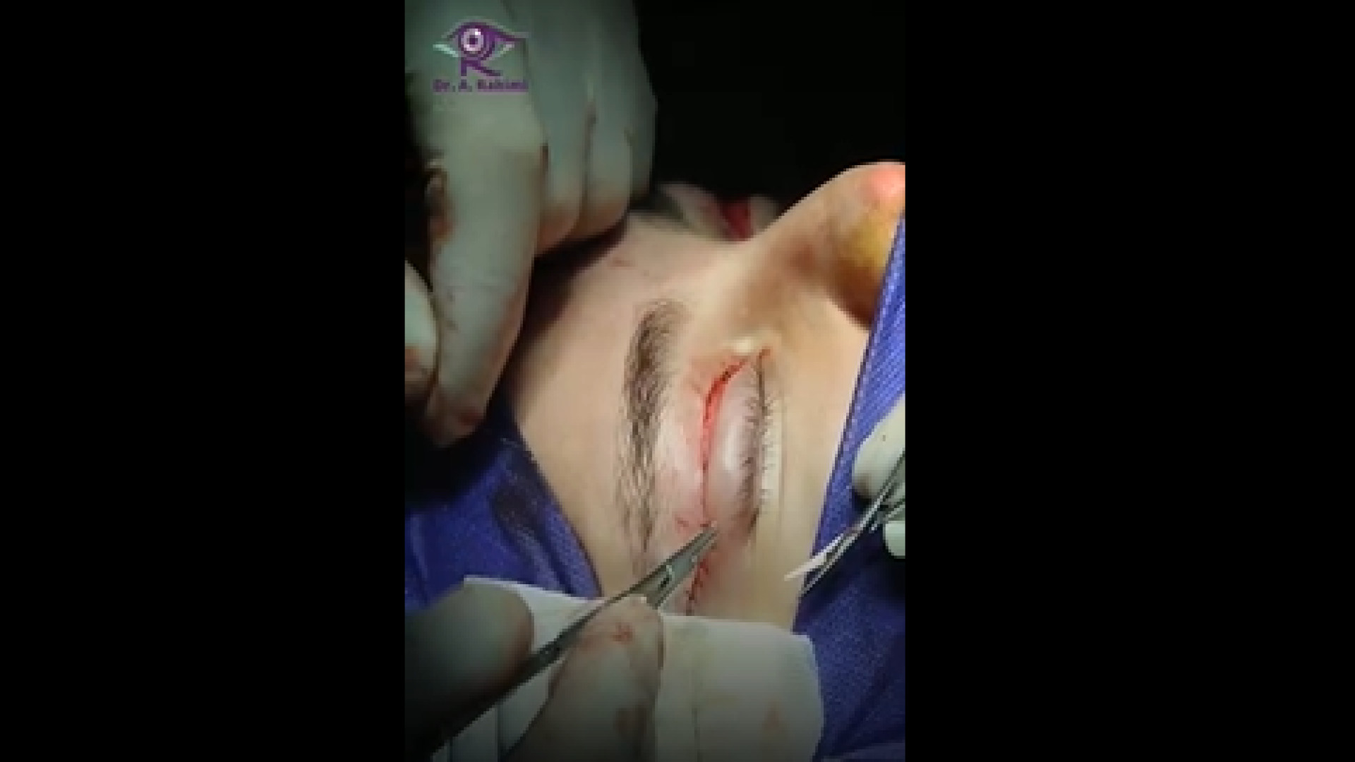 جراحی زیبایی پلک بالا دندان شیری