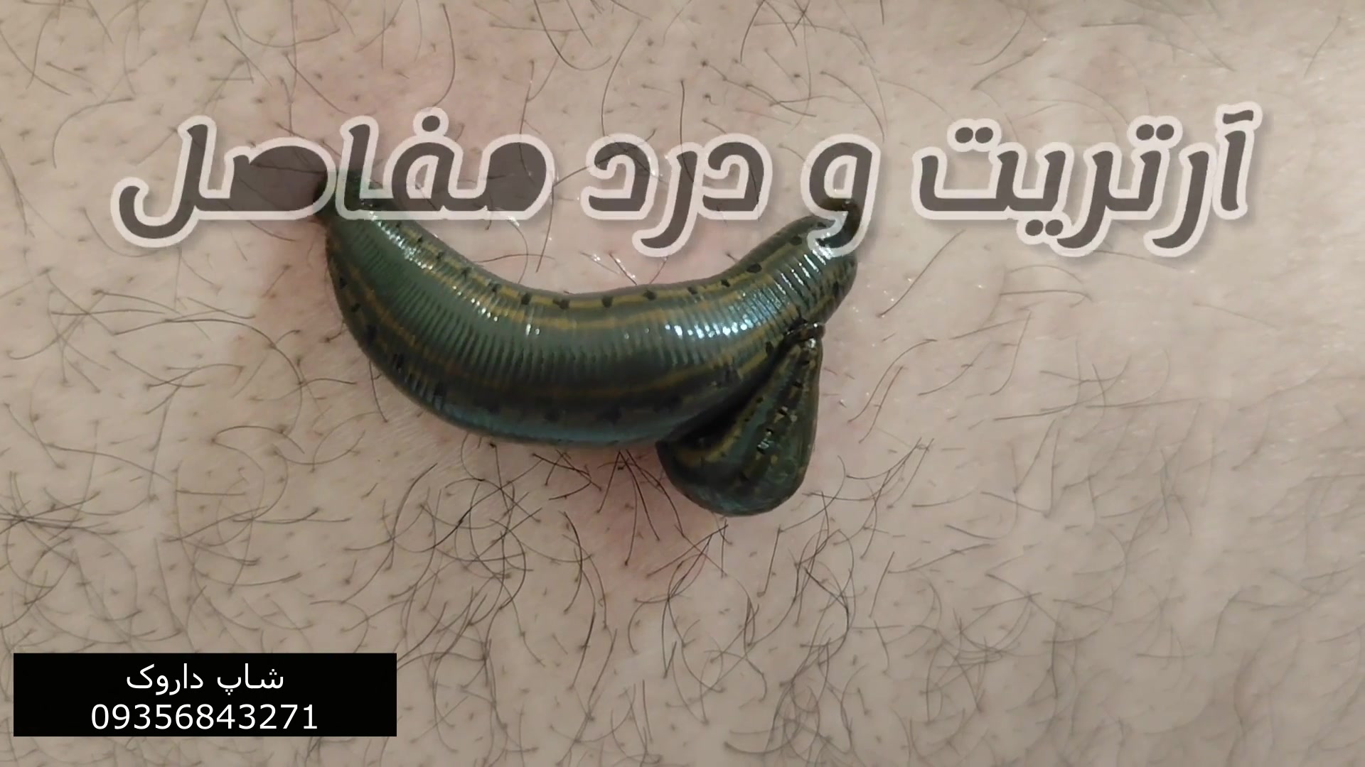 درمان فشارخون و سکته با زالو پالپوتومی