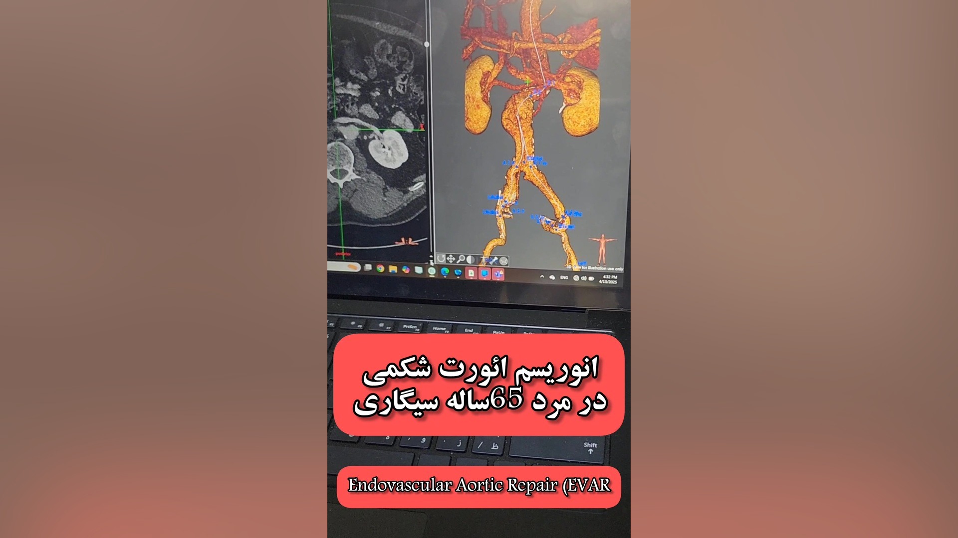 انوریسم ائورت شکمی و انجام TEVAR در بيمارستان رجائی میکروسفالی