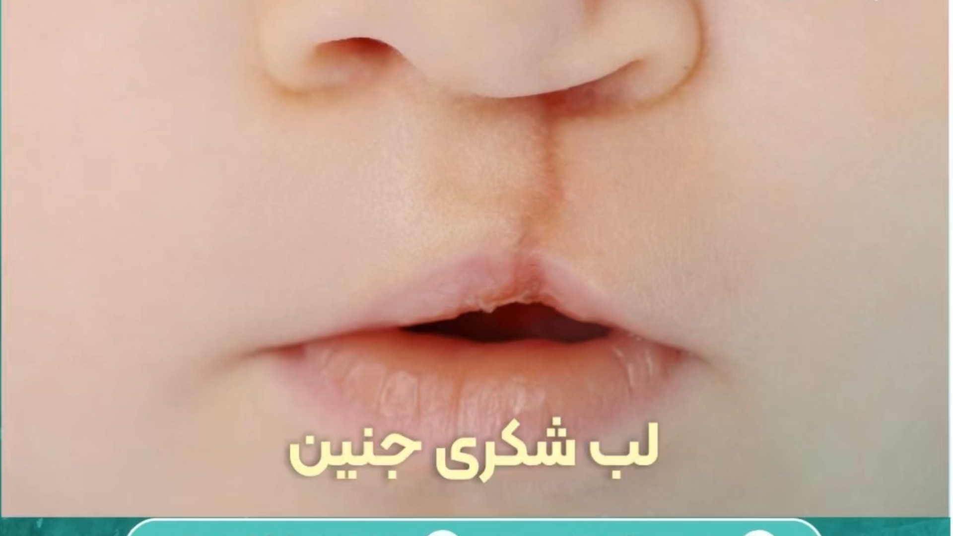 لب شکری در جنین: چطور تشخیص داده می‌شود و بعد از تولد چه باید کرد؟ پریناز ایزدیار