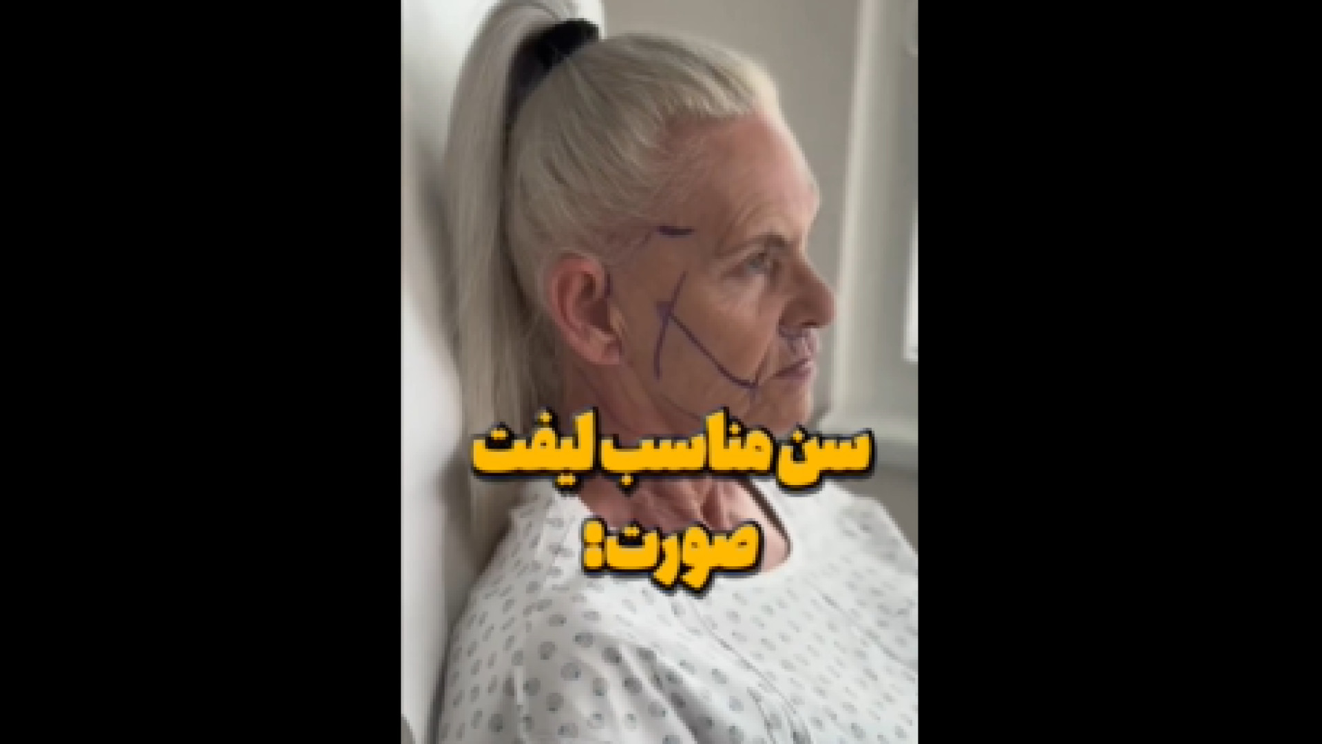سن مناسب لیفت صورت تزریق چربی