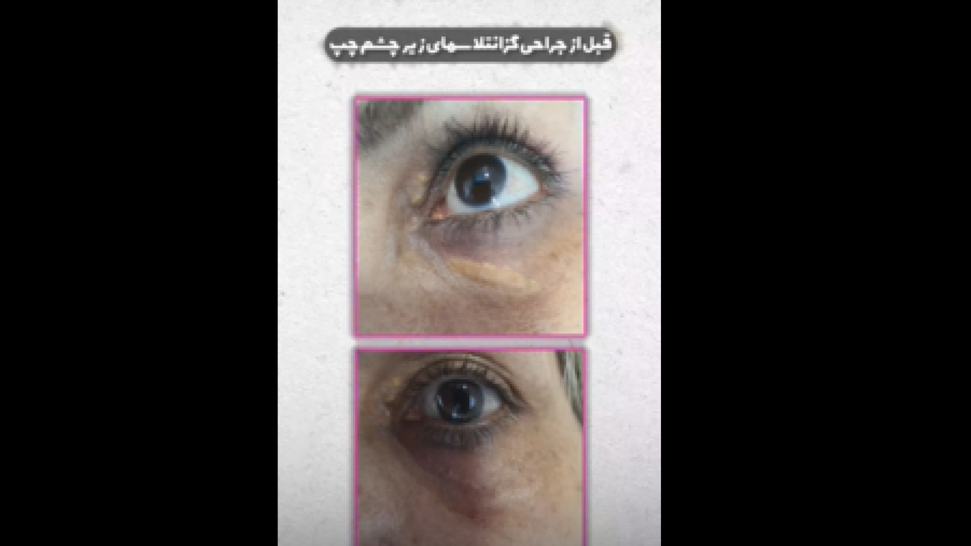 جراحی گزانتلاسما دکتر ایمان روغنی جراح و متخصص پوست و مو