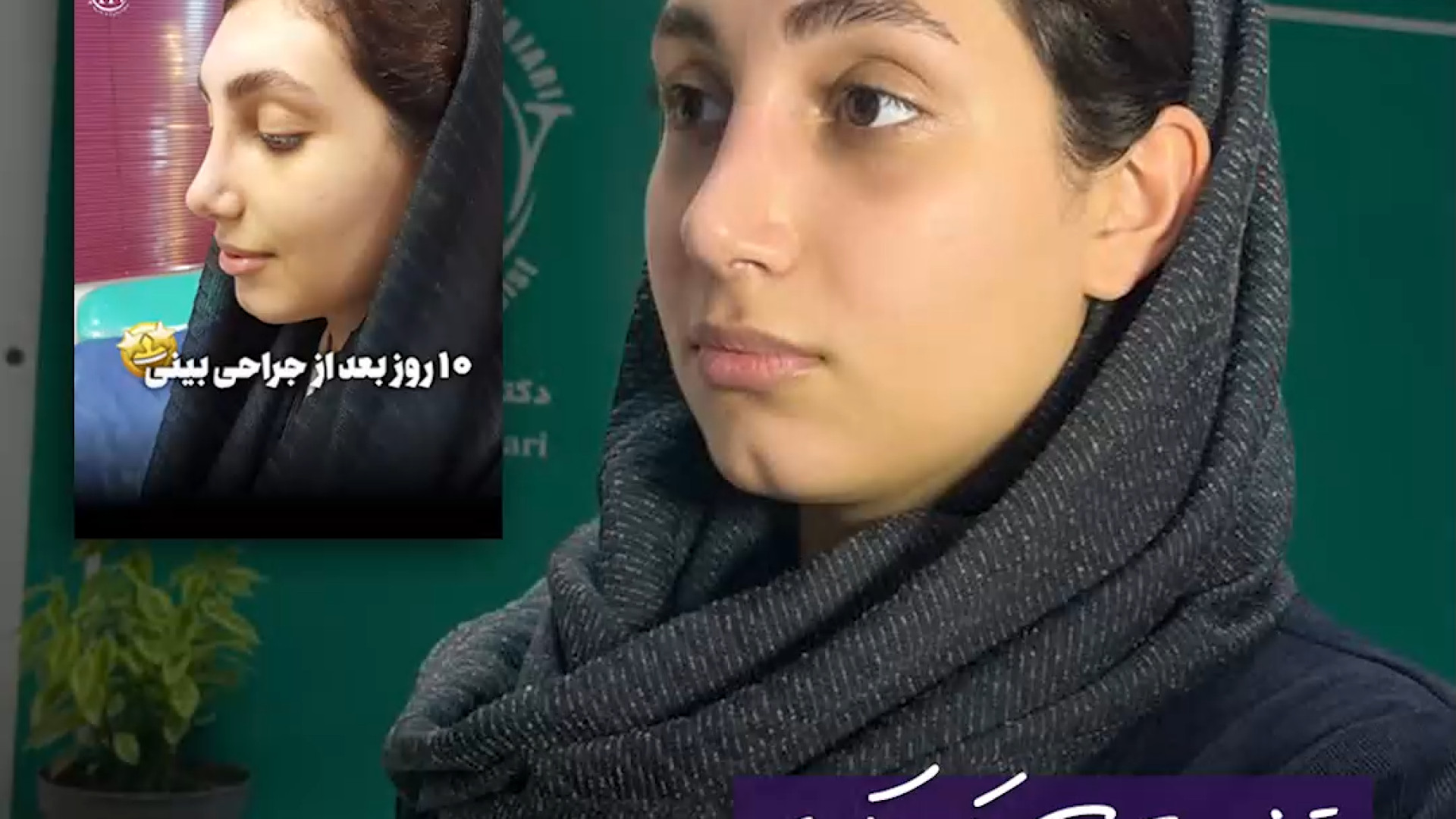 جراحی زیبایی بینی | دکتر علی حسینی واجاری دکتر علی حسینی واجاری - جراح بینی رشت