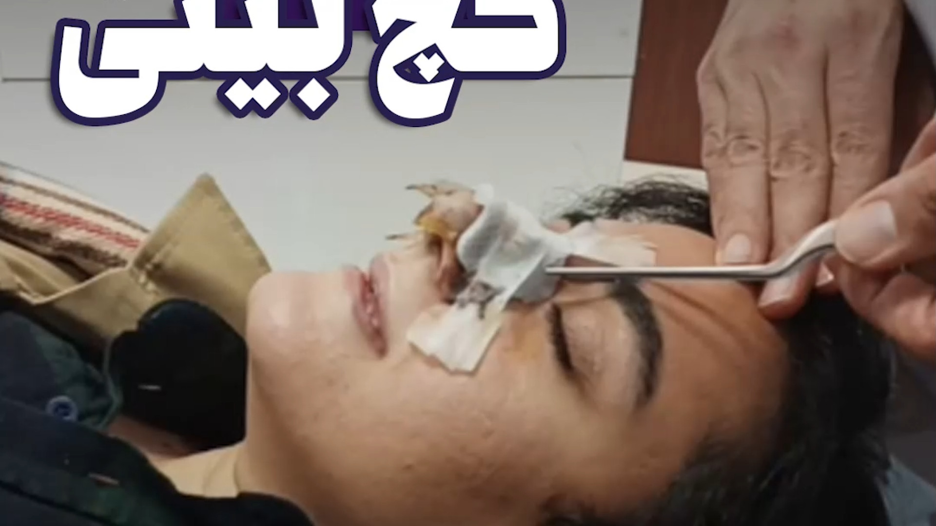 بلافاصله پس از برداشتن گچ بینی | دکتر علی حسینی واجاری دکتر علی حسینی واجاری - جراح بینی رشت