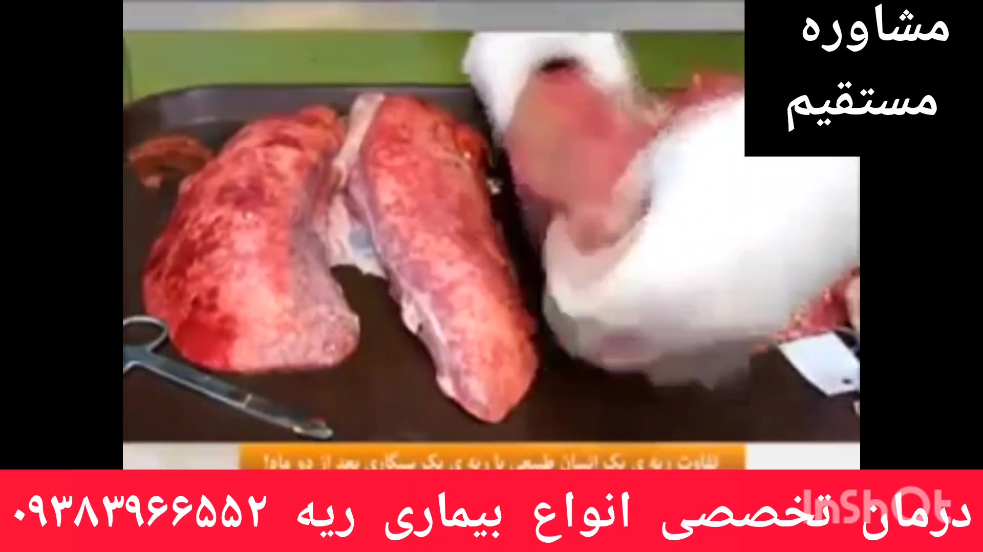 مشاوره ودرمان تخصصی بیماریهای ریوی۰۹۳۸۳۹۶۶۵۵۲ نپتوکلیب