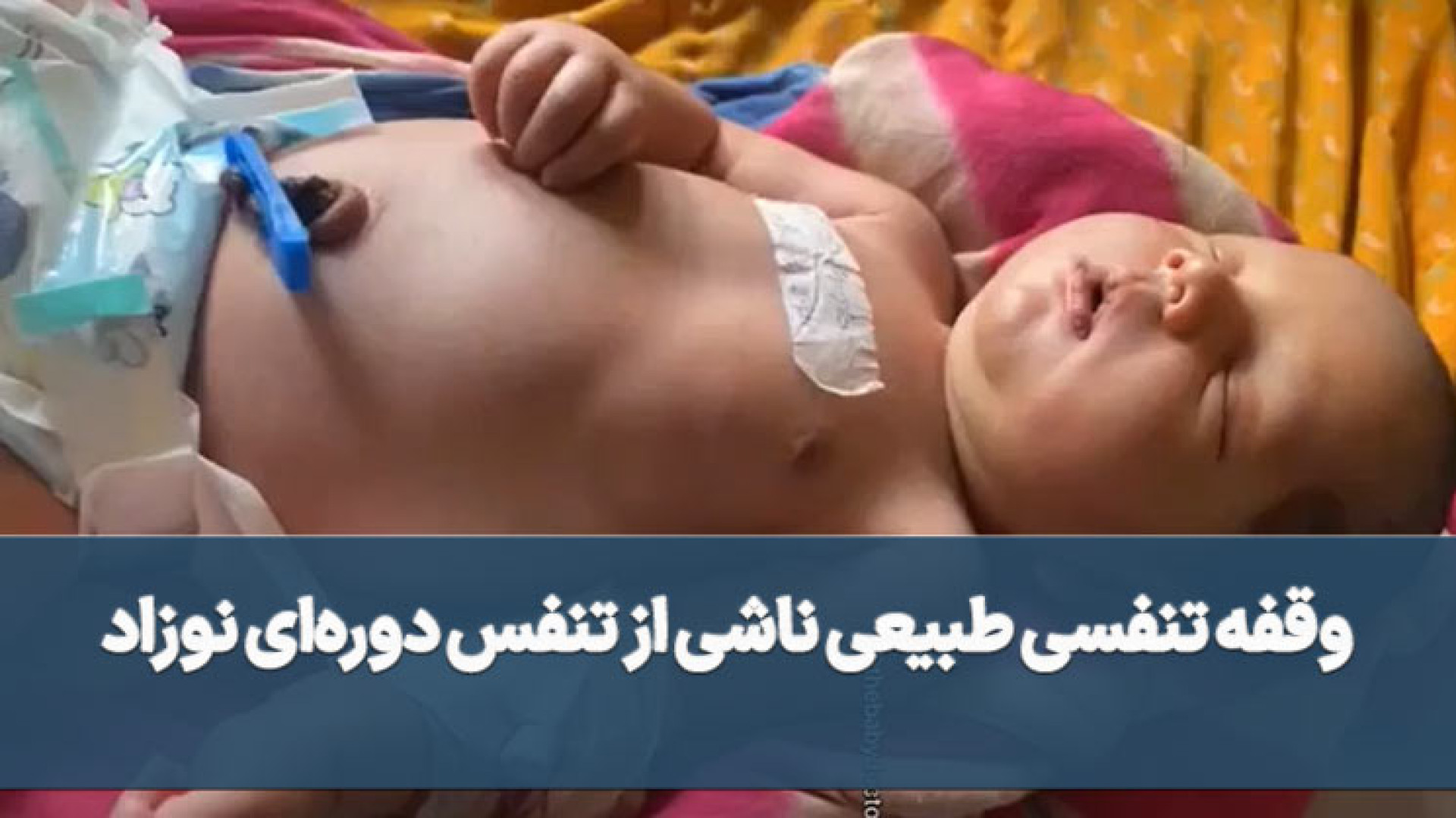ویدیو وقفه تنفسی طبیعی ناشی از تنفس دوره‌ای نوزاد سر به هوا