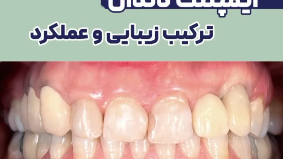 ایمپلنت دندان ترکیب زیبایی و عملکرد | دکتر ستاره هاشمی