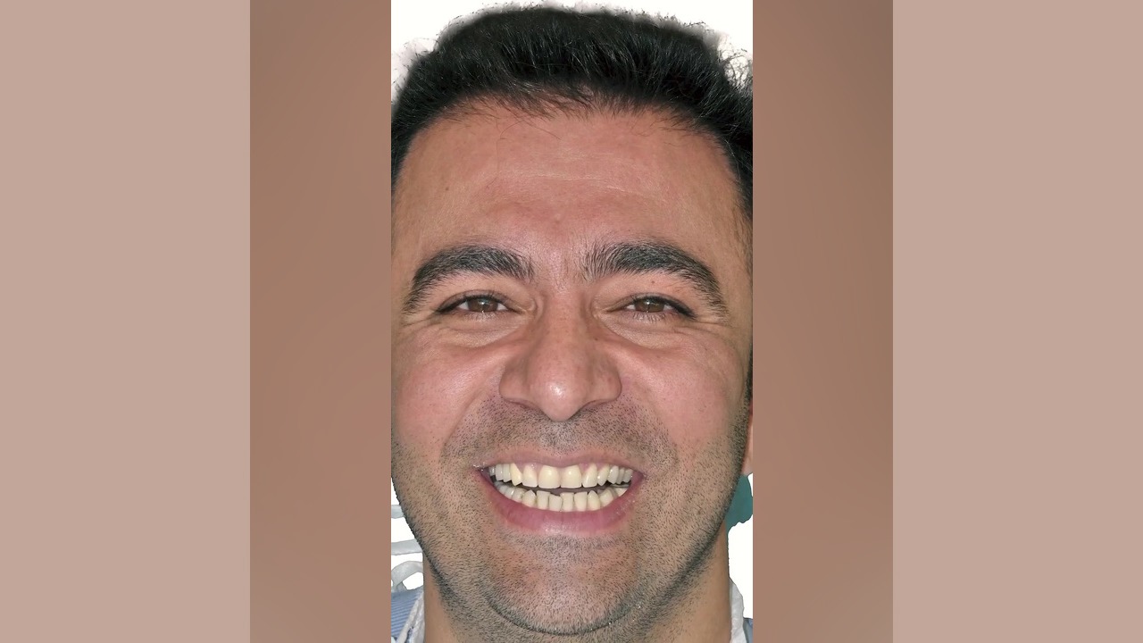 تغییر اساسی با اصلاح لبخند توپلیزوماب