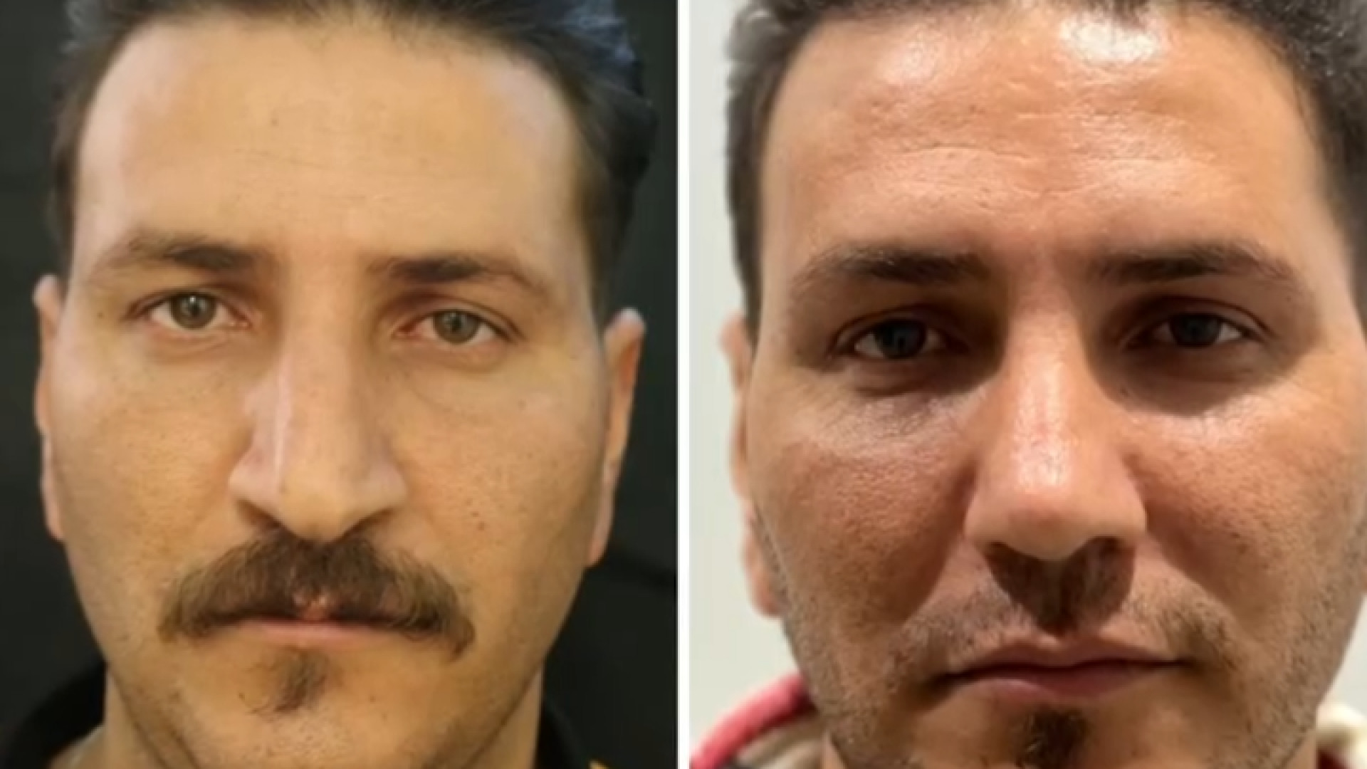عمل بینی گوشتی در آقایان دکتر شاهین بهجو - فوق تخصص جراحی پلاستیک