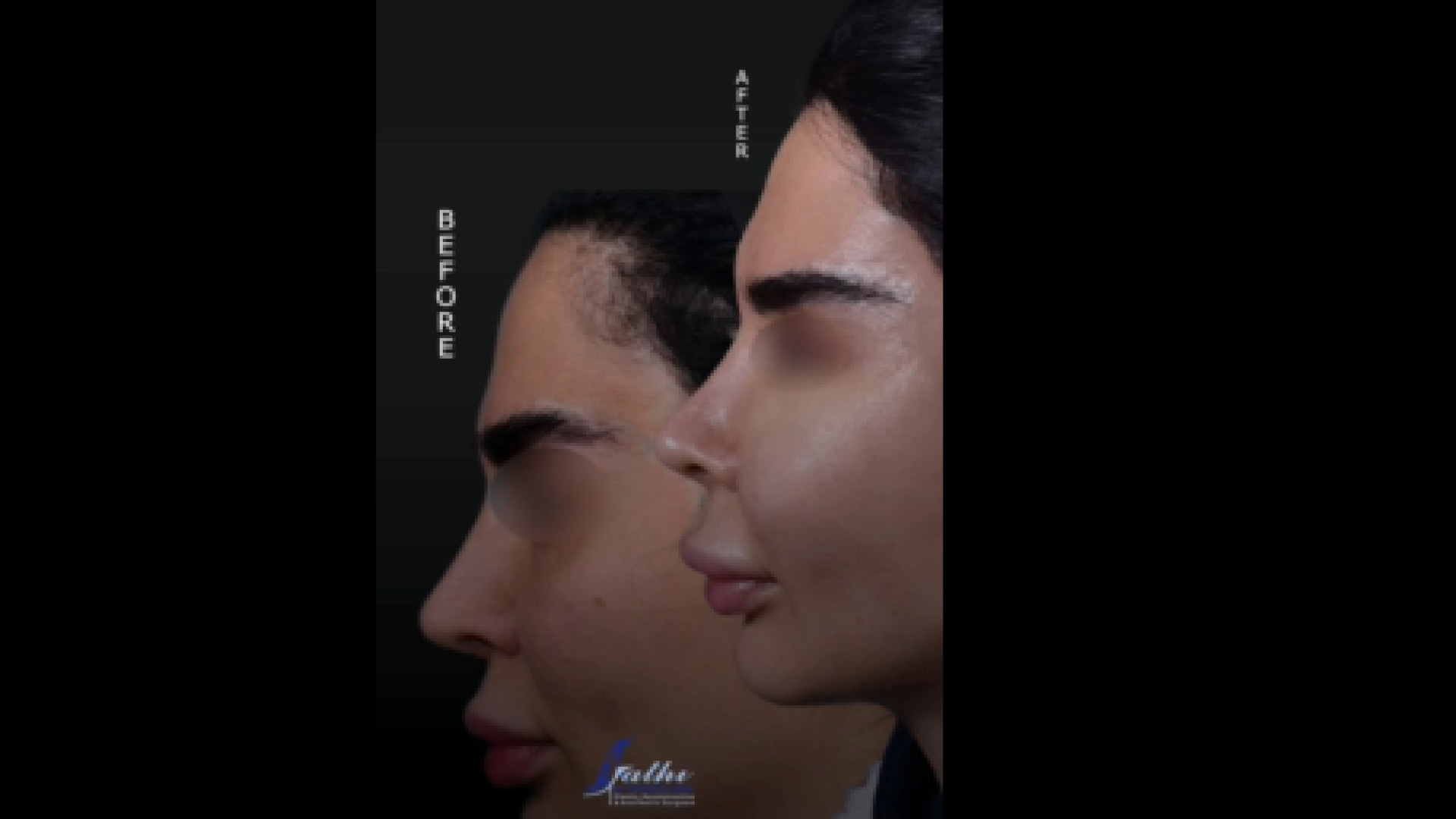 جراحی لیفت گونه برای مراجعه کننده عزیز دکتر حمید رضا فتحی فوق تخصص جراحی پلاستیک