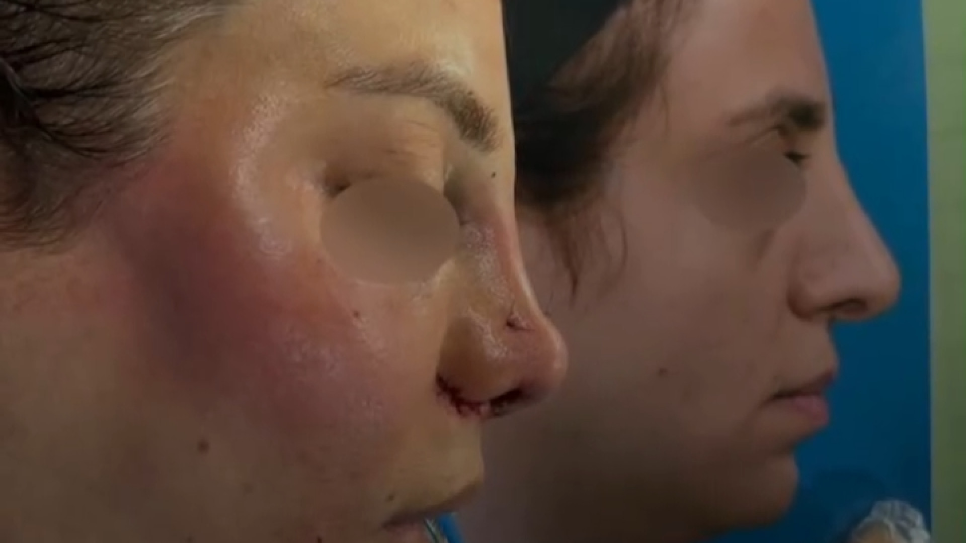 جراحی بینی ترمیمی دکتر حمید رضا فتحی فوق تخصص جراحی پلاستیک