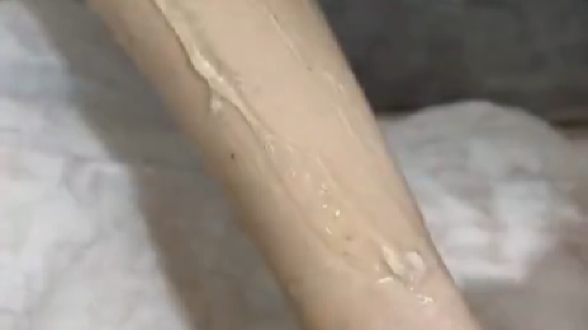 بهترین کلینیک لیزر موهای زائد در سعادت آباد | ابوالفضل حکیم پور بیماری پورفیری اریتروپوئتیک