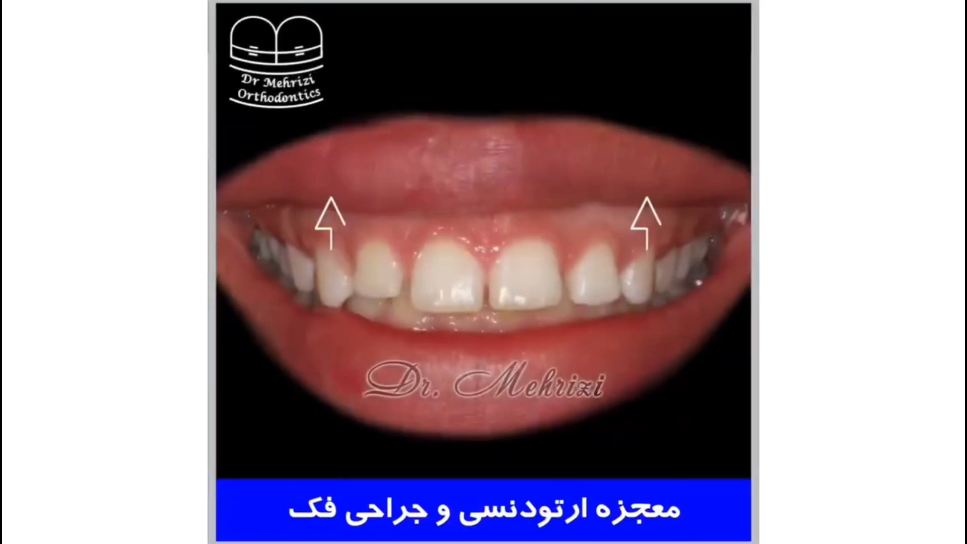 معجزه ارتودنسی و جراحی فک بیماری اورنیتین ترانس کاربامیلاز