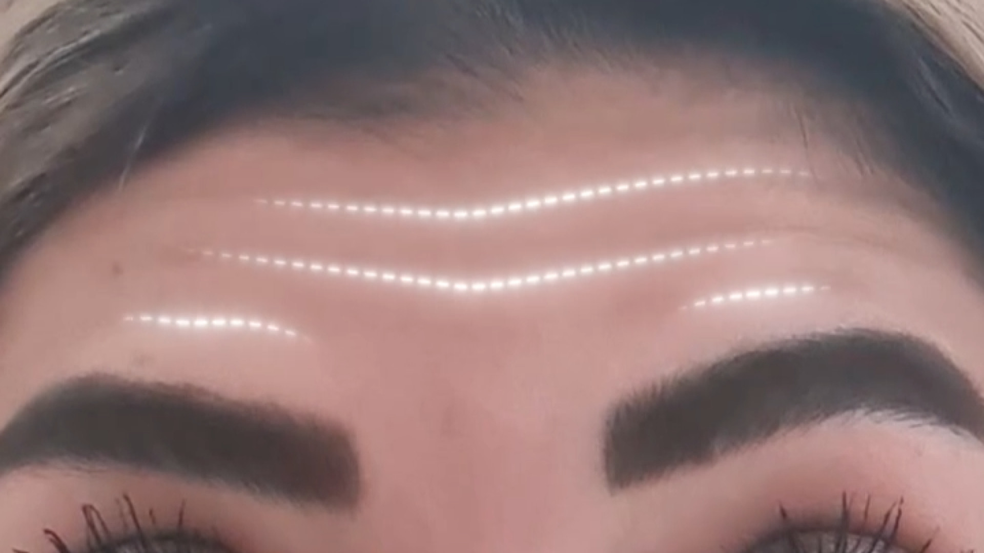 نتیجه ی بوتاکس! | دکتر مریم بیکی دکتر مریم بیکی - پوست و مو و زیبایی اراک