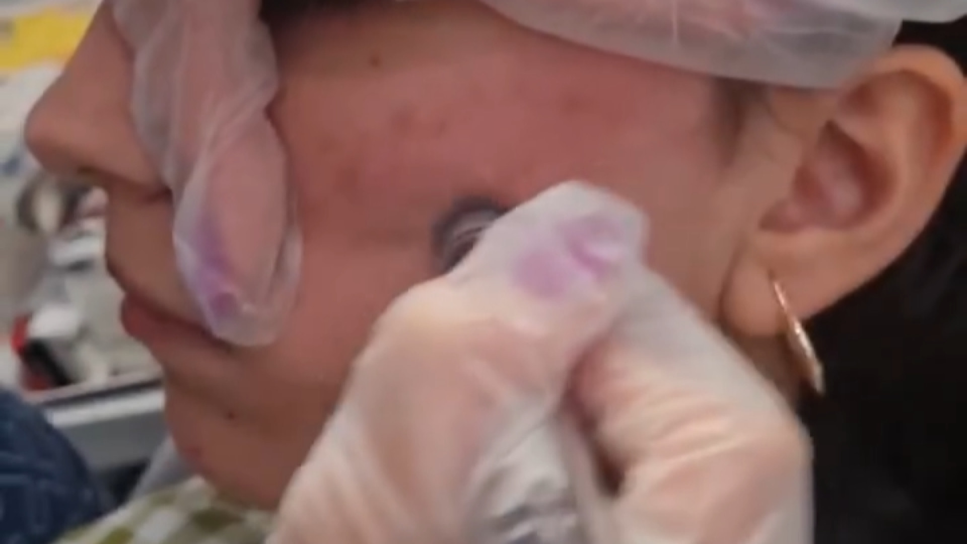 میکرودرم | دکتر مریم بیکی دکتر مریم بیکی - پوست و مو و زیبایی اراک