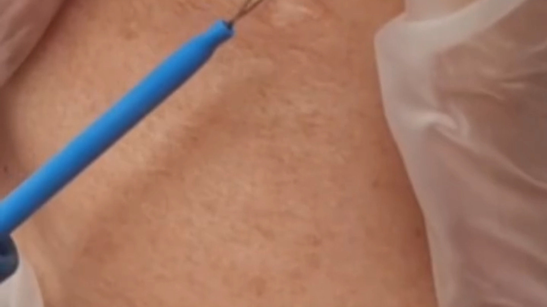 رفع لک صورت | دکتر مریم بیکی دکتر مریم بیکی - پوست و مو و زیبایی اراک