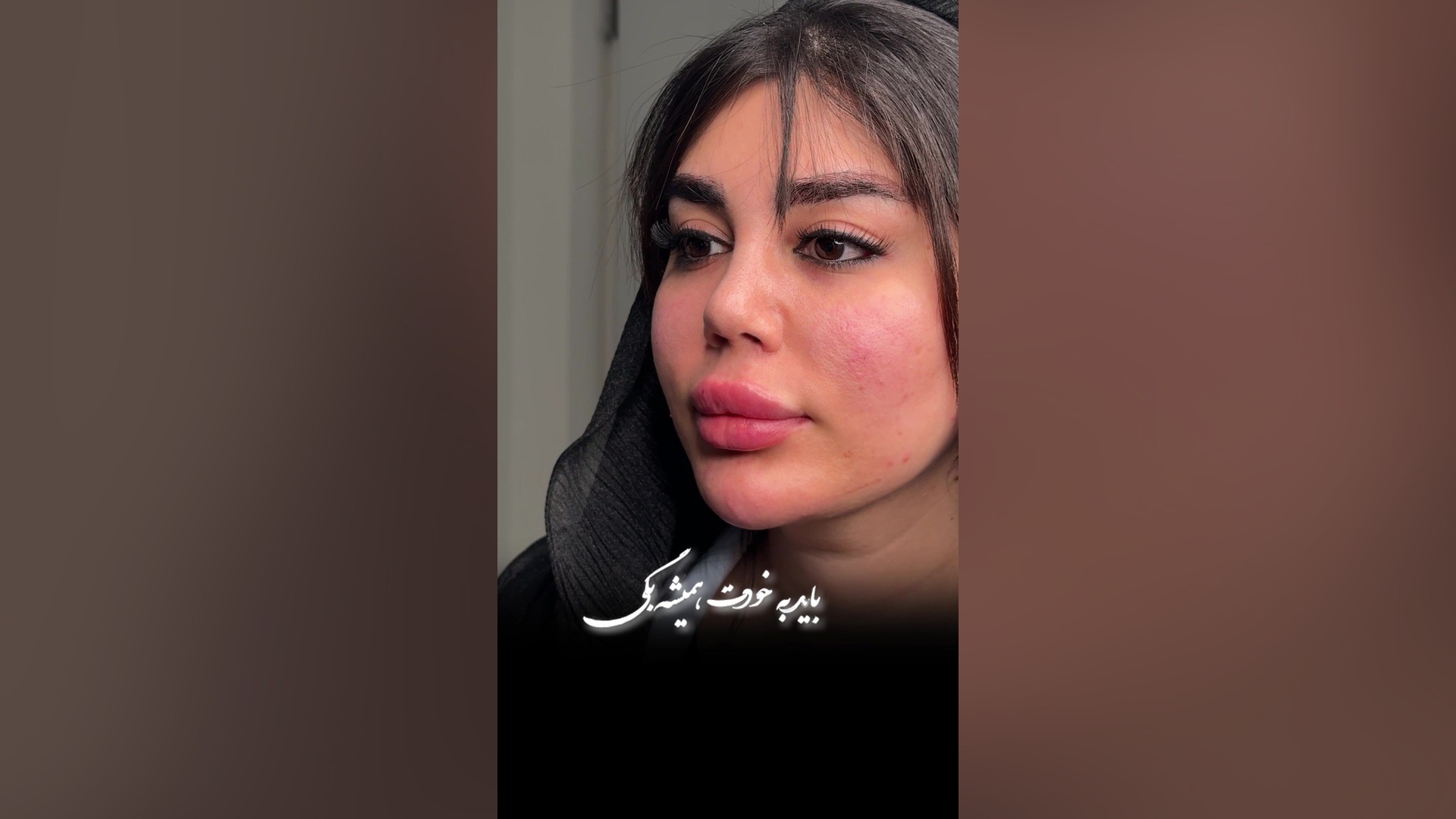 تزریق لب روسی و چانه در رشت کلینیک زیبایی رشت دکتر مهدیه حسین زاده