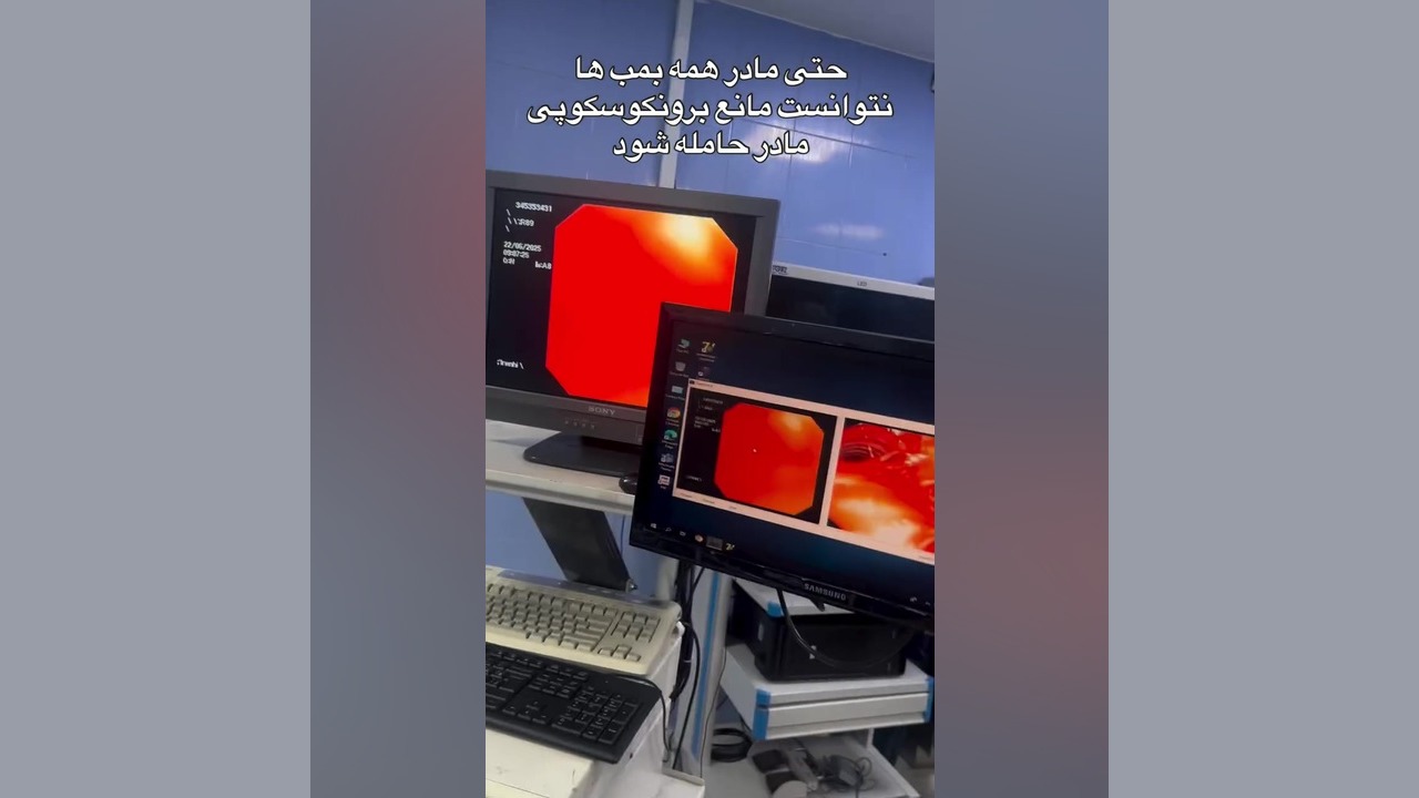 برونکوسکوپی مادر حامله در جنگ دکتر اردا کیانی