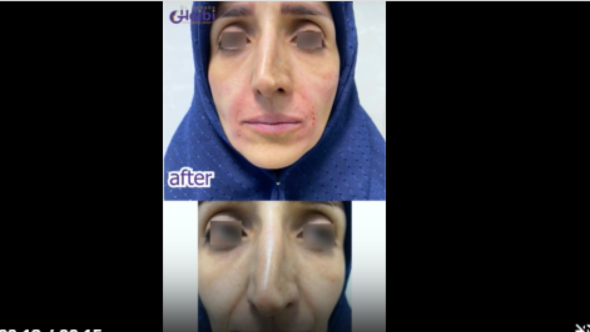 تزریق ژل خط خنده دکتر ربابه غیبی
