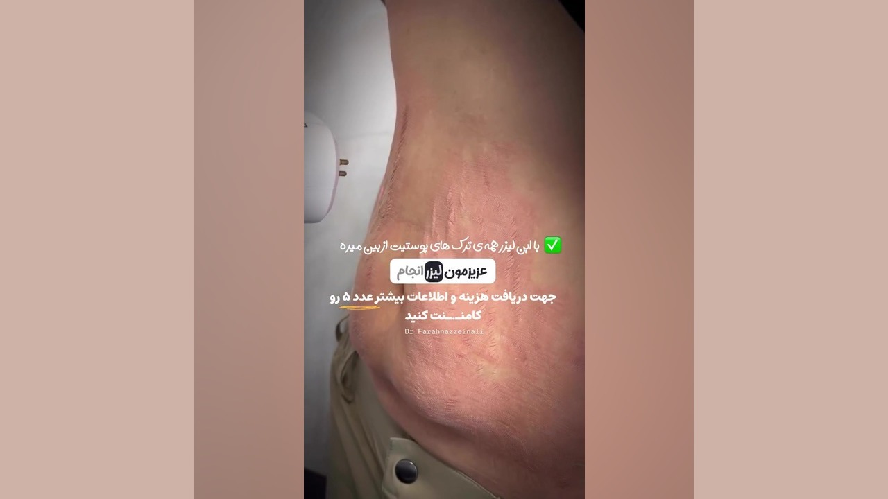 لیزرco2 موریکسل با تکنولوژی روز دنیا، ترک های پوستی رو محو می کنه دکتر فرحناز زینعلی - متخصص پوست، مو، زیبایی زنجان