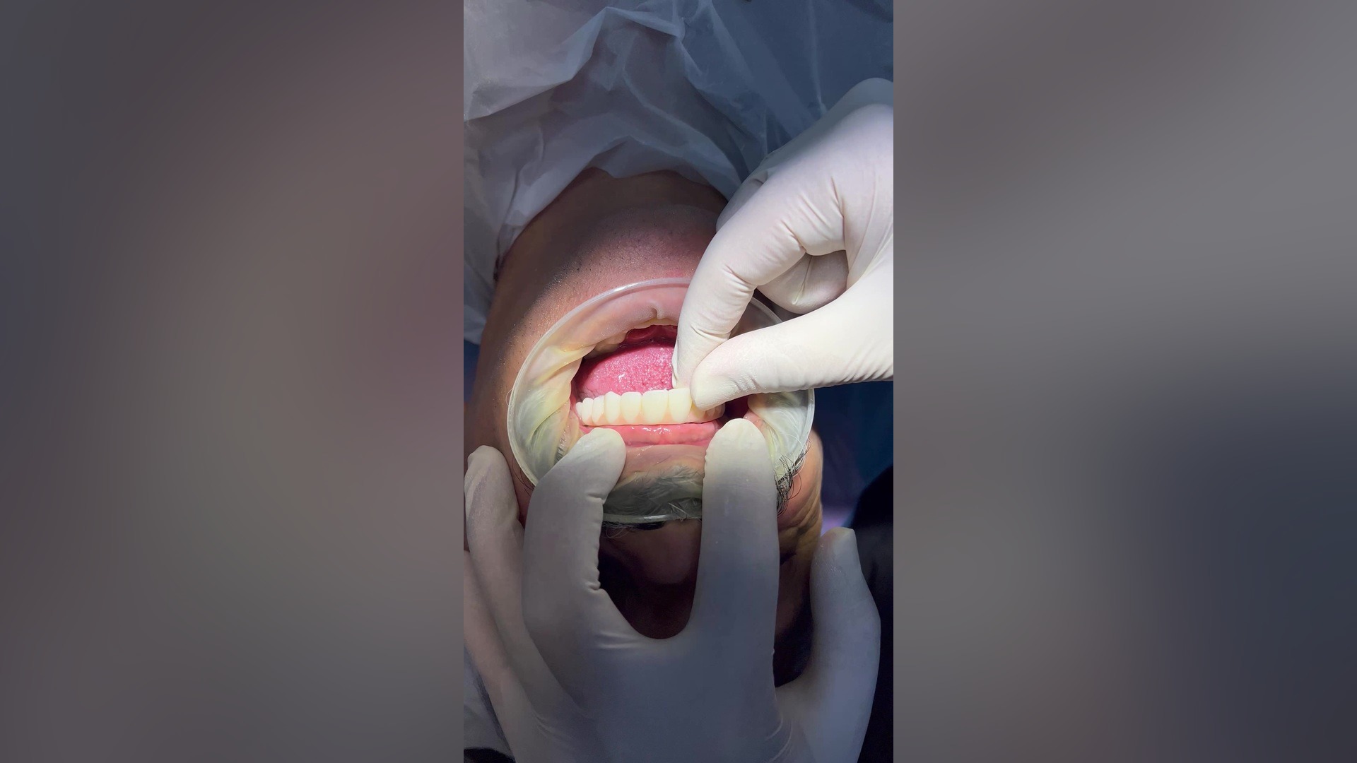 پیشرفته ترین حالت ایمپلنت تمام فک دیجیتال در شیراز | دکتر عرفان صفری ایربسارتان