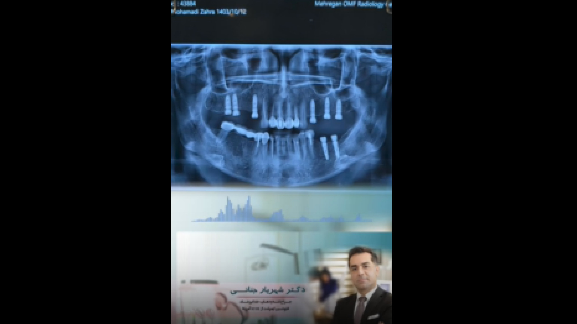 نمونه کار ایمپلنت دندان با کمک اسکن فک تست انعقاد PT/PTT