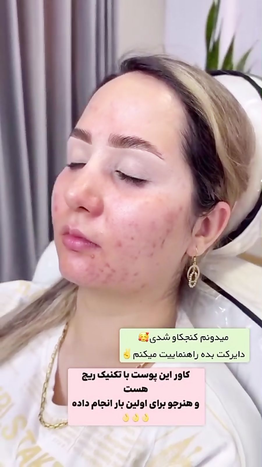 جدیدترین و ماندگارترین تکنیک پوست سازی ریچ