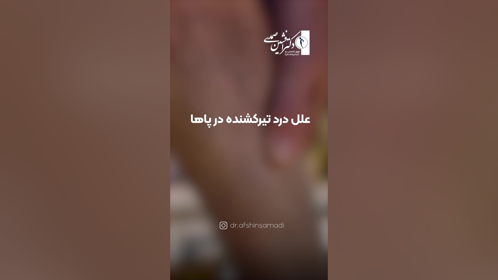 سندرم پیریفورمیس سلنا گومز